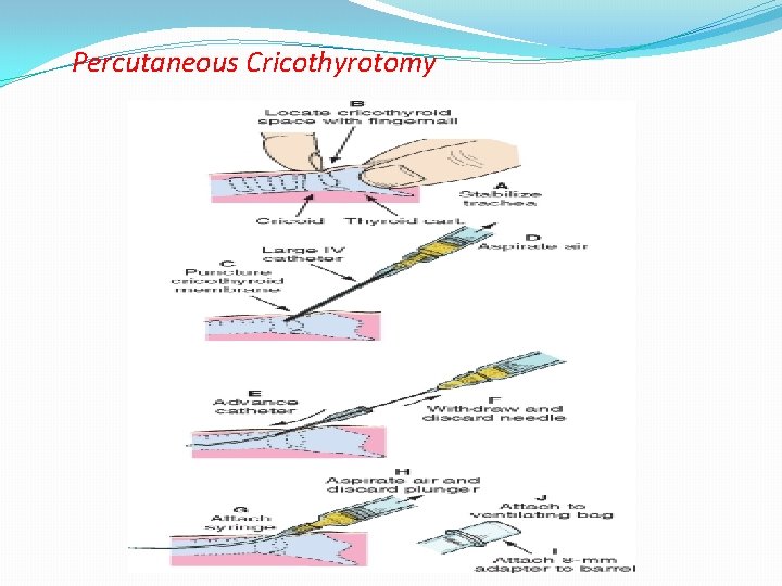 Percutaneous Cricothyrotomy 