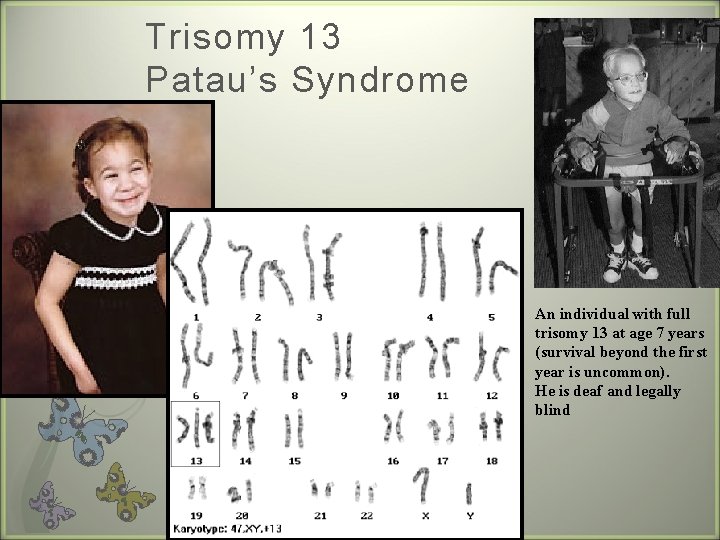 Trisomy 13 Patau’s Syndrome An individual with full trisomy 13 at age 7 years