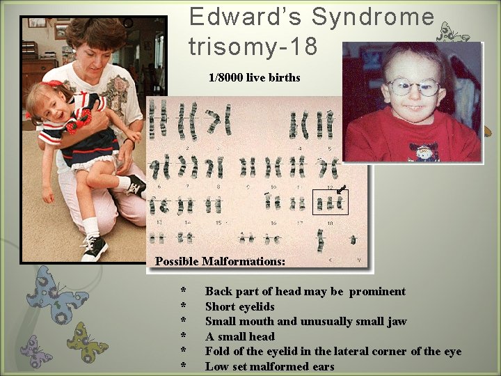 Edward’s Syndrome trisomy-18 1/8000 live births Possible Malformations: * * * Back part of