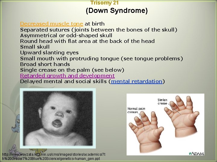 Trisomy 21 (Down Syndrome) Decreased muscle tone at birth Separated sutures (joints between the