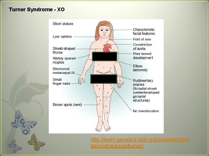 Turner Syndrome - XO http: //learn. genetics. utah. edu/content/disor ders/whataregd/turner/ 