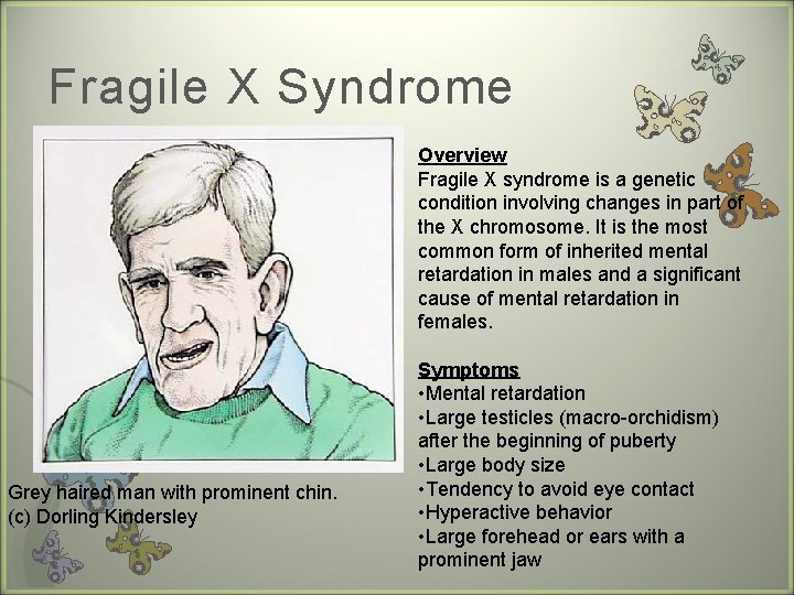 Fragile X Syndrome Overview Fragile X syndrome is a genetic condition involving changes in