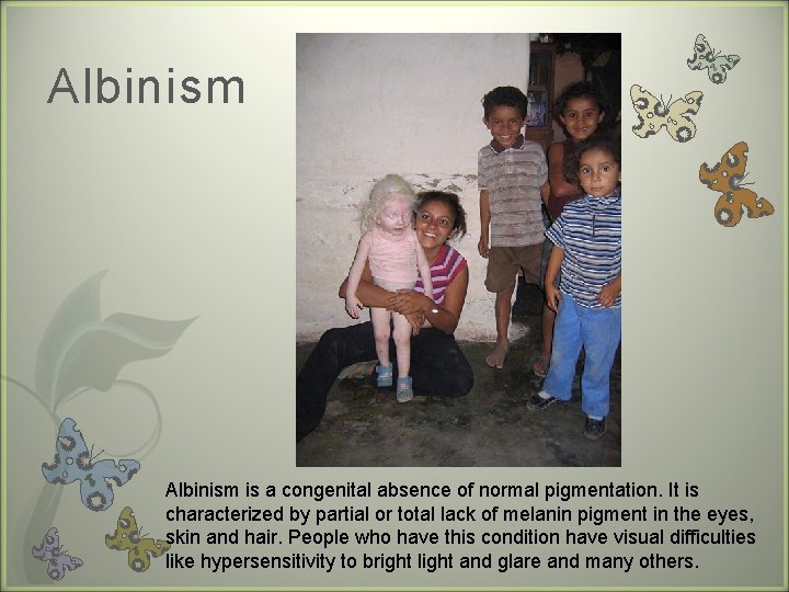 Albinism is a congenital absence of normal pigmentation. It is characterized by partial or