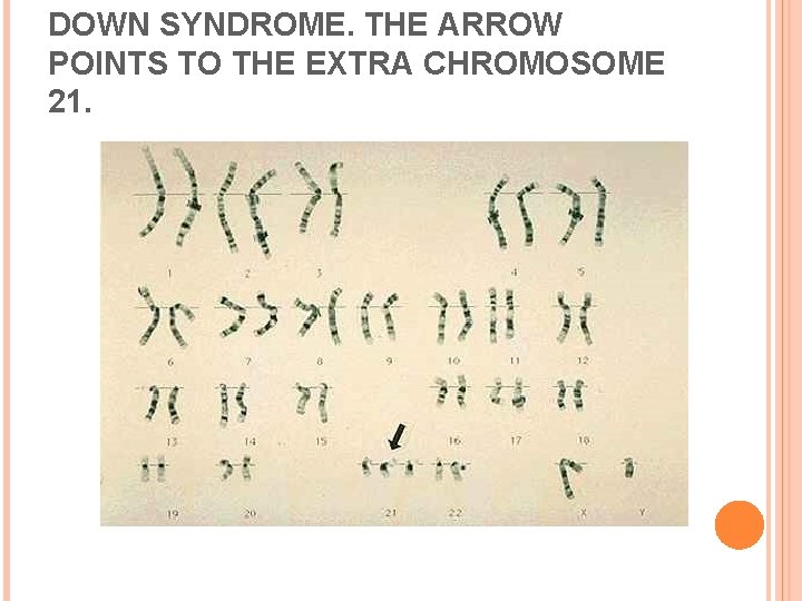 DOWN SYNDROME. THE ARROW POINTS TO THE EXTRA CHROMOSOME 21. 