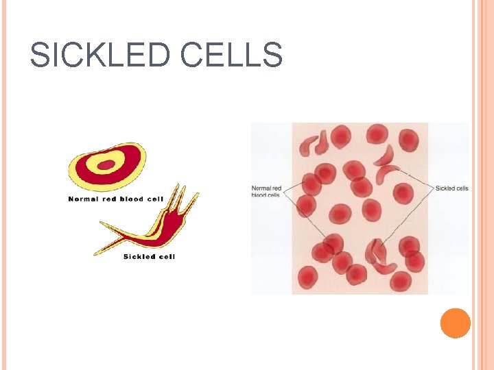 SICKLED CELLS 
