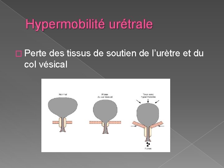 Hypermobilité urétrale � Perte des tissus de soutien de l’urètre et du col vésical