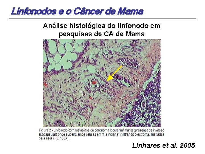 Linfonodos e o Câncer de Mama Análise histológica do linfonodo em pesquisas de CA