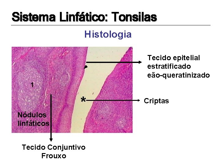 Sistema Linfático: Tonsilas Histologia Tecido epitelial estratificado eão-queratinizado Criptas Nódulos linfáticos Tecido Conjuntivo Frouxo