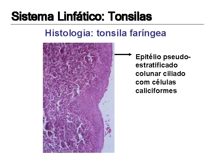 Sistema Linfático: Tonsilas Histologia: tonsila faríngea Epitélio pseudoestratificado colunar ciliado com células caliciformes 