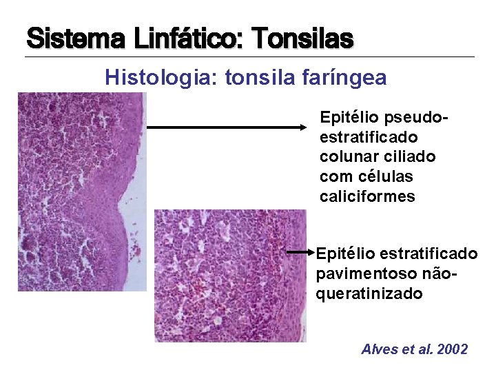 Sistema Linfático: Tonsilas Histologia: tonsila faríngea Epitélio pseudoestratificado colunar ciliado com células caliciformes Epitélio