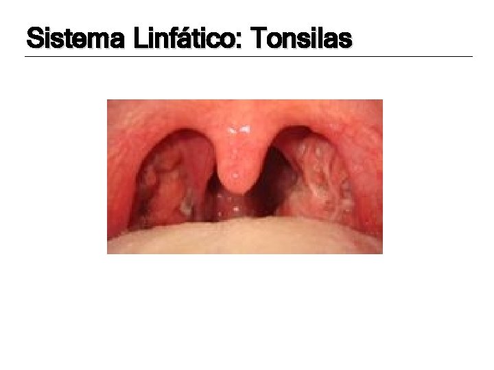 Sistema Linfático: Tonsilas 