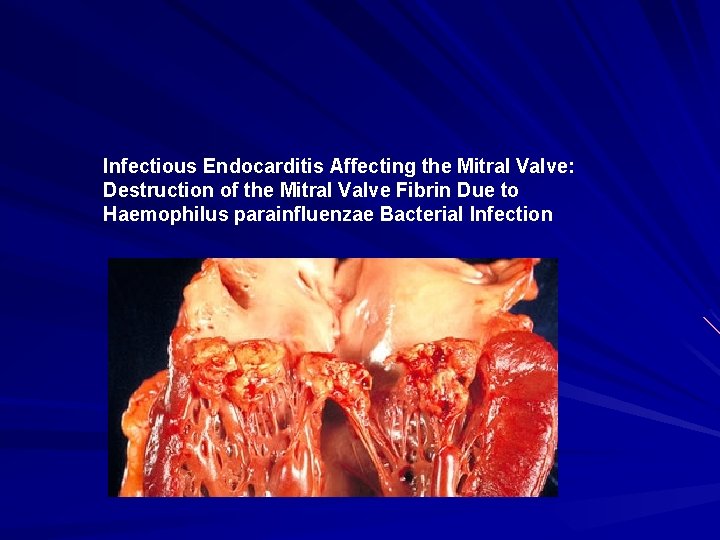 Infectious Endocarditis Affecting the Mitral Valve: Destruction of the Mitral Valve Fibrin Due to