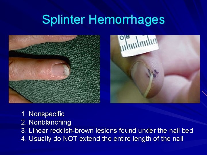 Splinter Hemorrhages 1. Nonspecific 2. Nonblanching 3. Linear reddish-brown lesions found under the nail