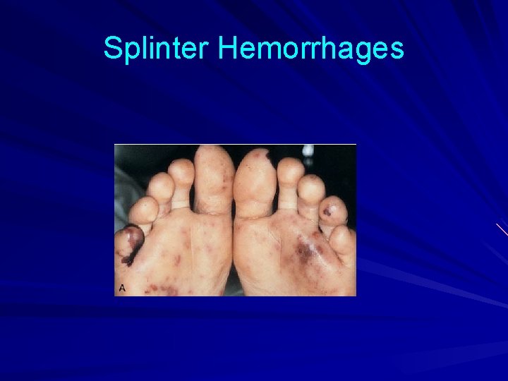 Splinter Hemorrhages 