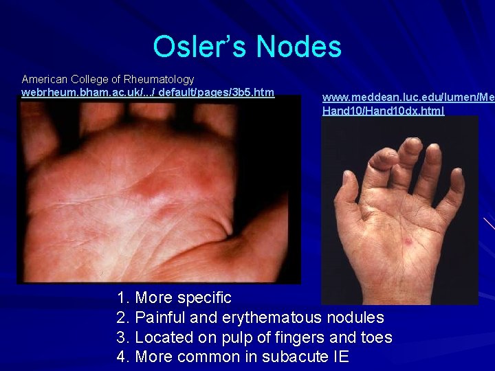 Osler’s Nodes American College of Rheumatology webrheum. bham. ac. uk/. . . / default/pages/3