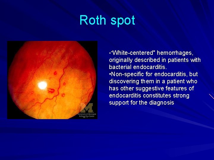 Roth spot • “White-centered" hemorrhages, originally described in patients with bacterial endocarditis. • Non-specific