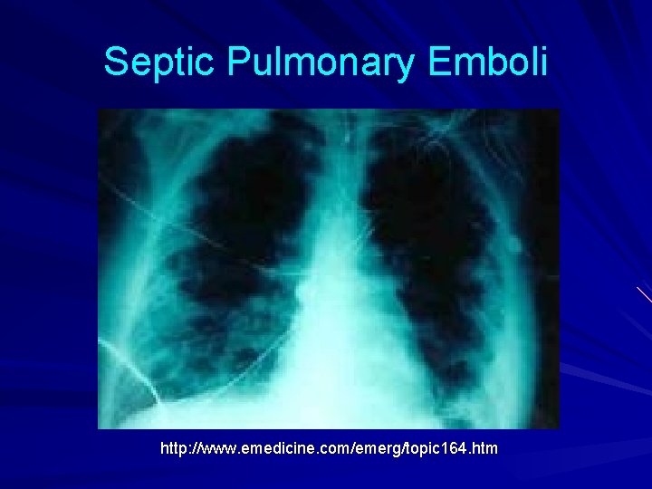 Septic Pulmonary Emboli http: //www. emedicine. com/emerg/topic 164. htm 