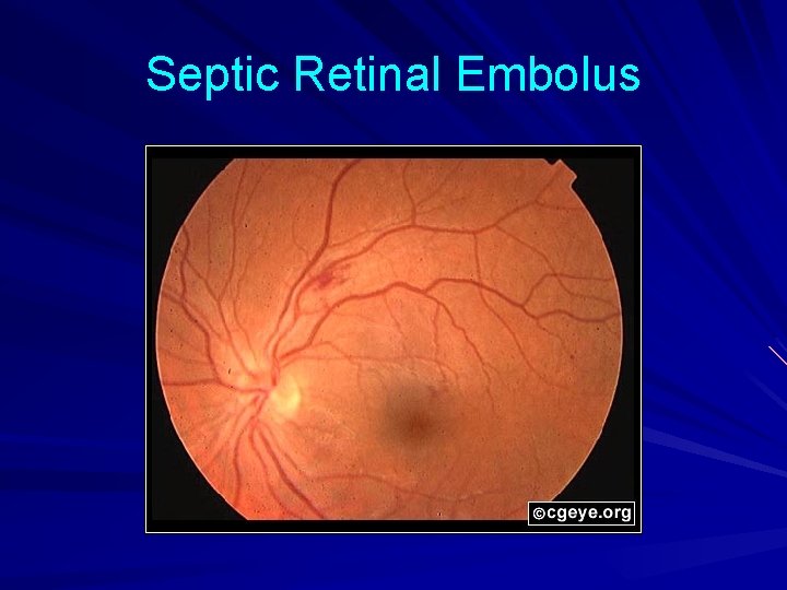 Septic Retinal Embolus 