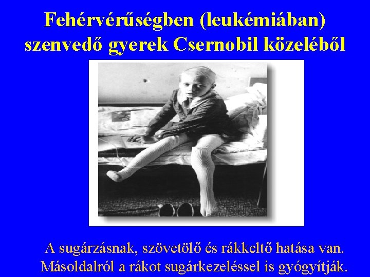 Fehérvérűségben (leukémiában) szenvedő gyerek Csernobil közeléből A sugárzásnak, szövetölő és rákkeltő hatása van. Másoldalról