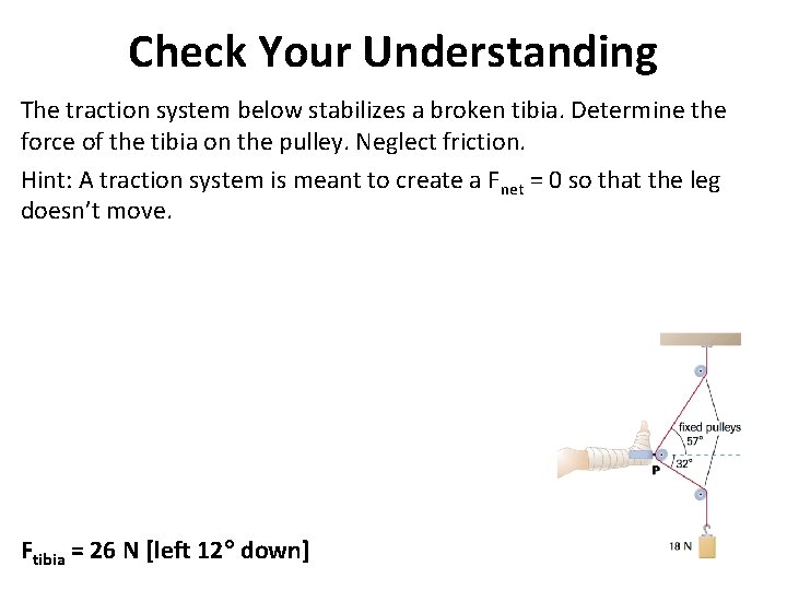 Check Your Understanding The traction system below stabilizes a broken tibia. Determine the force
