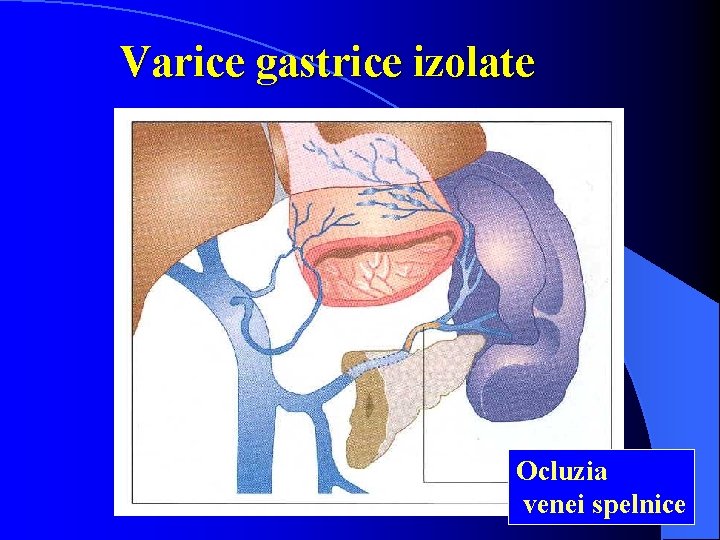 Varicele esofagiene | Gastroenterologie | Ghid de boli