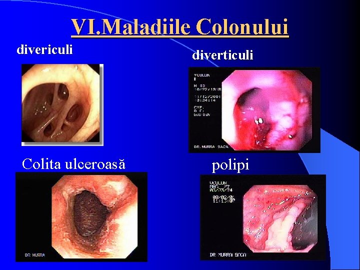 VI. Maladiile Colonului divericuli Colita ulceroasă diverticuli polipi 