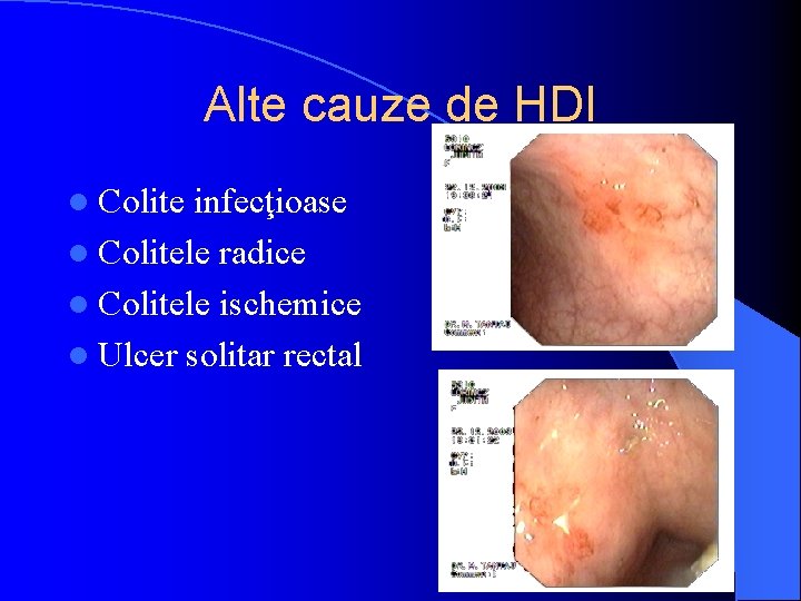 Alte cauze de HDI l Colite infecţioase l Colitele radice l Colitele ischemice l