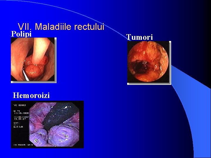 VII. Maladiile rectului Polipi Hemoroizi Tumori 