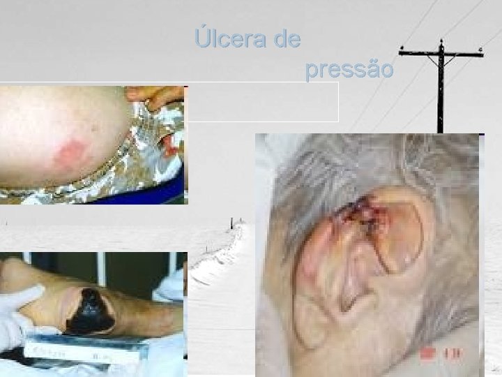 Úlcera de pressão 