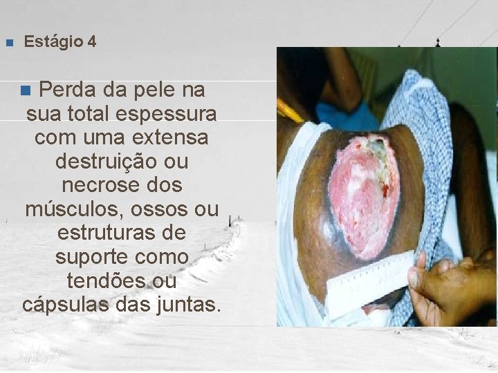 n Estágio 4 Perda da pele na sua total espessura com uma extensa destruição