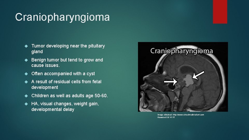 Craniopharyngioma Tumor developing near the pituitary gland Benign tumor but tend to grow and