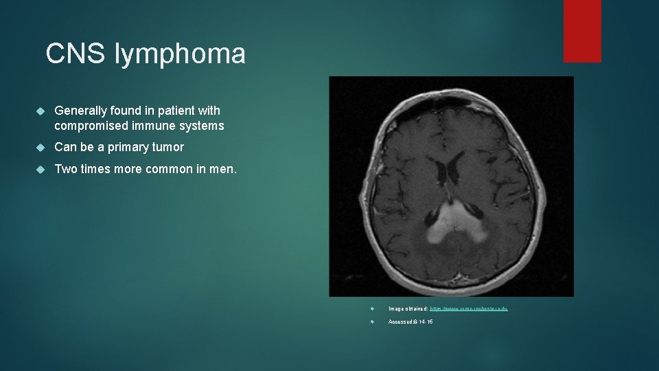 CNS lymphoma Generally found in patient with compromised immune systems Can be a primary