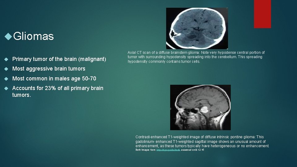  Gliomas Primary tumor of the brain (malignant) Most aggressive brain tumors Most common