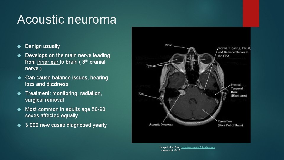 Acoustic neuroma Benign usually Develops on the main nerve leading from inner ear to