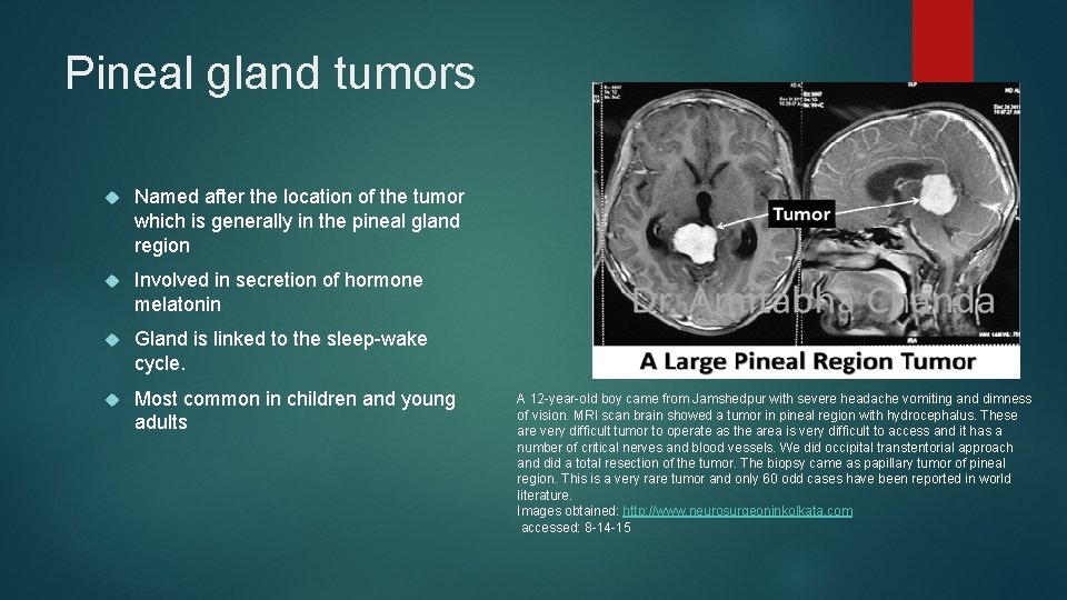 Pineal gland tumors Named after the location of the tumor which is generally in