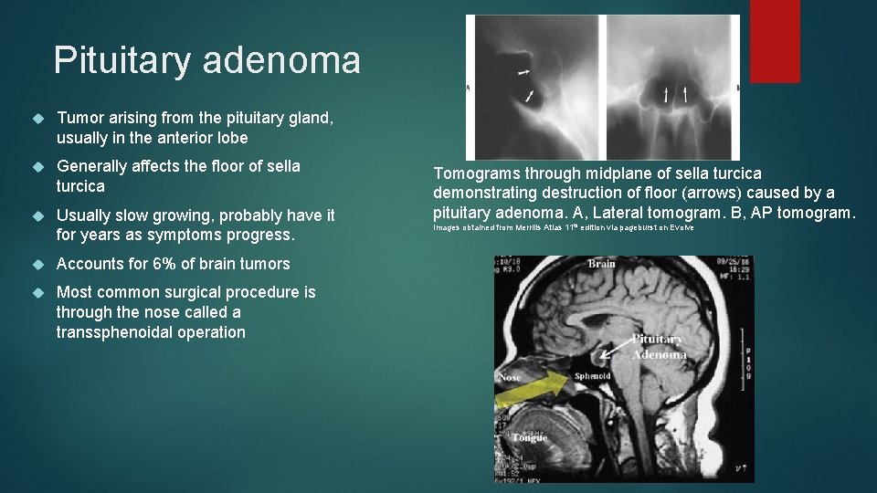 Pituitary adenoma Tumor arising from the pituitary gland, usually in the anterior lobe Generally