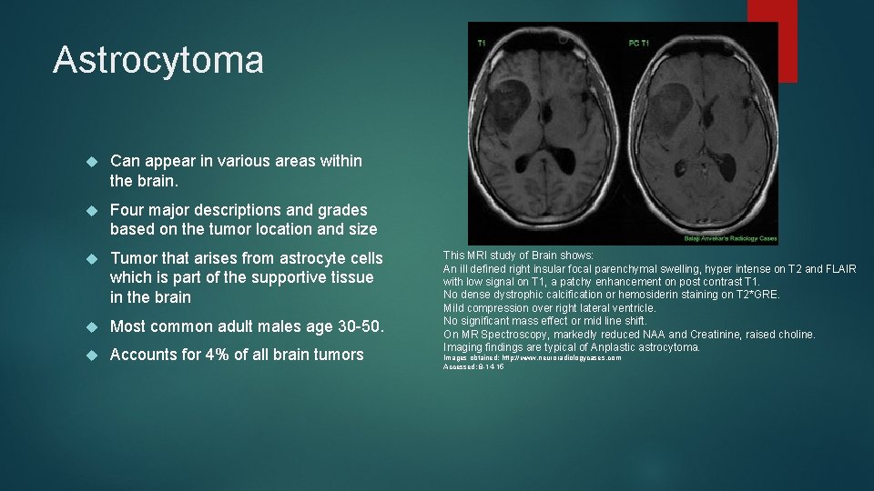 Astrocytoma Can appear in various areas within the brain. Four major descriptions and grades