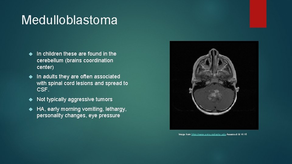 Medulloblastoma In children these are found in the cerebellum (brains coordination center) In adults