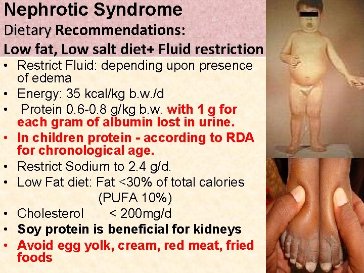 Nephrotic Syndrome Dietary Recommendations: Dietary Low fat, Low salt diet+ Fluid restriction • Restrict