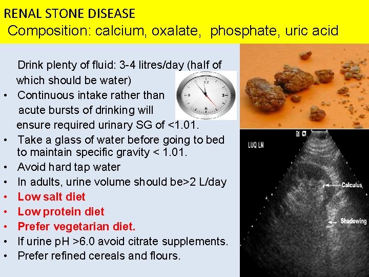 RENAL STONE DISEASE Composition: calcium, oxalate, phosphate, uric acid • • • Drink plenty