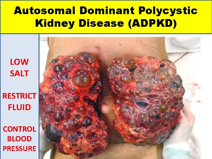 Autosomal Dominant Polycystic Kidney Disease (ADPKD) LOW SALT RESTRICT FLUID CONTROL BLOOD PRESSURE 