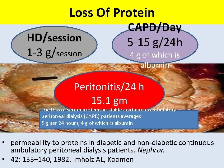 Loss Of Protein HD/session 1 -3 g/session • • CAPD/Day 5 -15 g/24 h