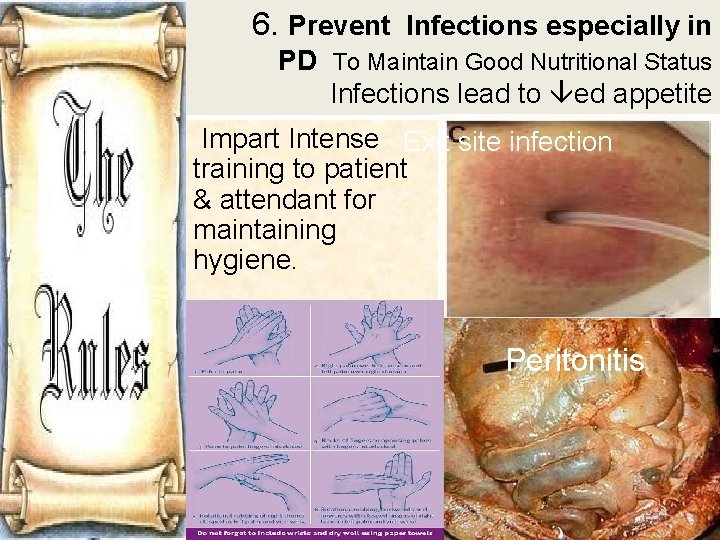 6. Prevent Infections especially in PD To Maintain Good Nutritional Status Infections lead to