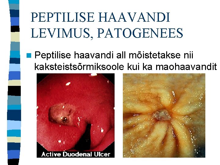 PEPTILISE HAAVANDI LEVIMUS, PATOGENEES n Peptilise haavandi all mõistetakse nii kaksteistsõrmiksoole kui ka maohaavandit