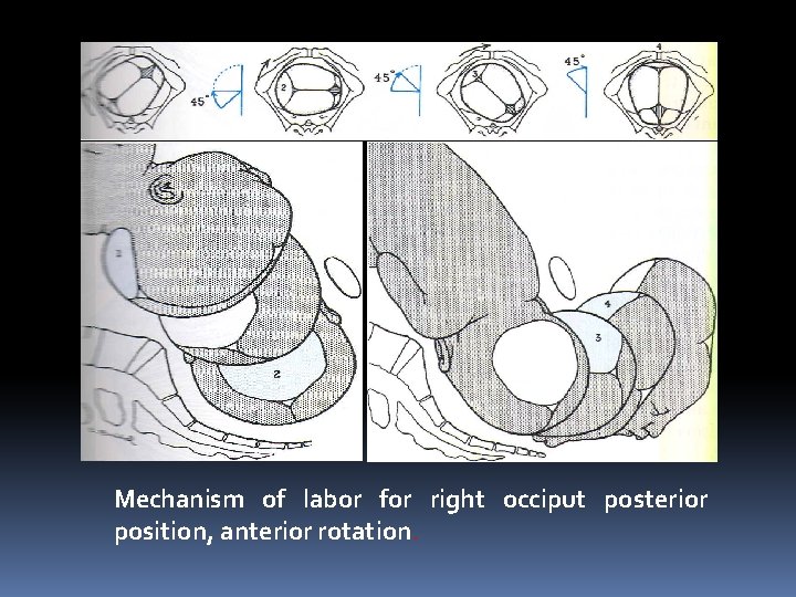 Mechanism of labor for right occiput posterior position, anterior rotation. 