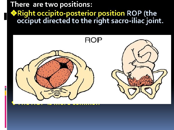 There are two positions: Right occipito-posterior position ROP (the occiput directed to the right