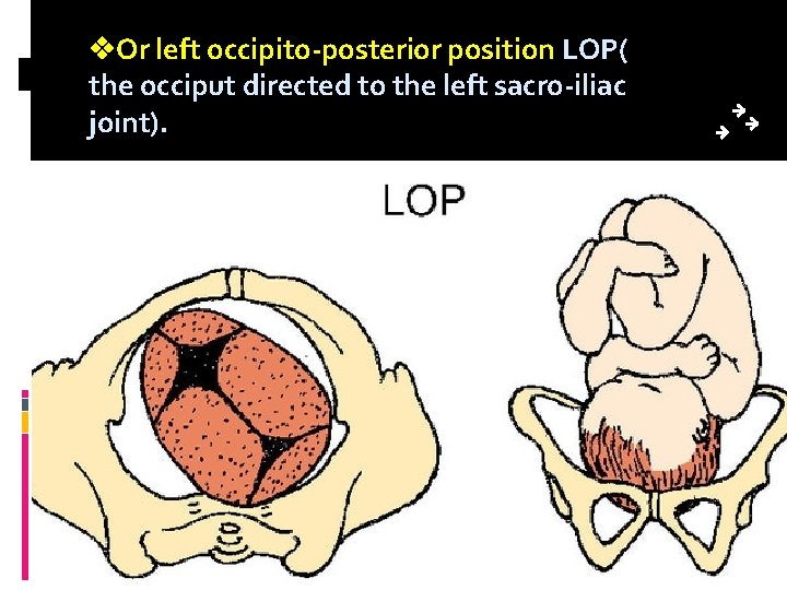  Or left occipito-posterior position LOP( the occiput directed to the left sacro-iliac joint).