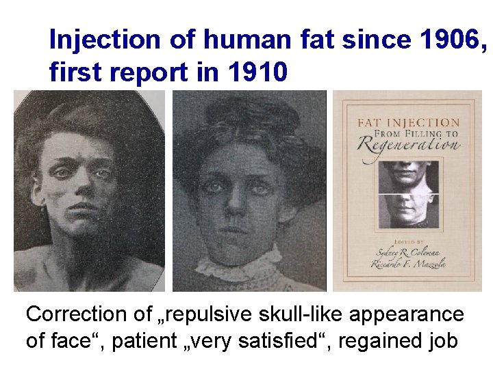 Injection of human fat since 1906, first report in 1910 Correction of „repulsive skull-like Injection of human fat since 1906, first report in 1910 Correction of „repulsive skull-like