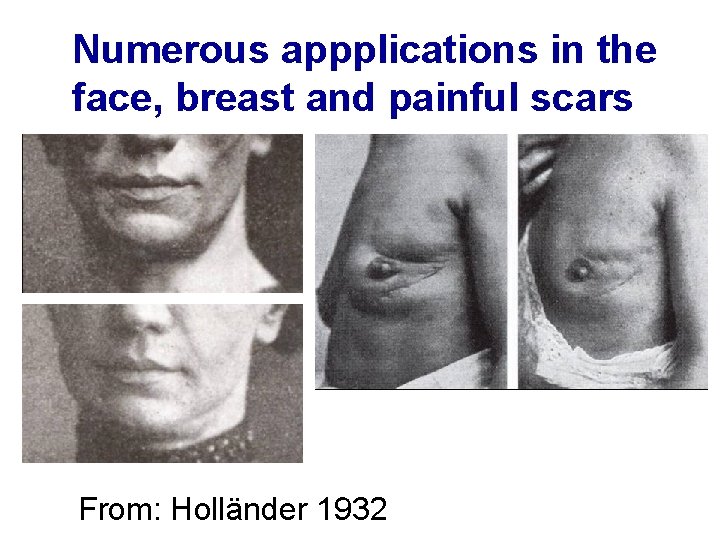 Numerous appplications in the face, breast and painful scars From: Holländer 1932 Numerous appplications in the face, breast and painful scars From: Holländer 1932