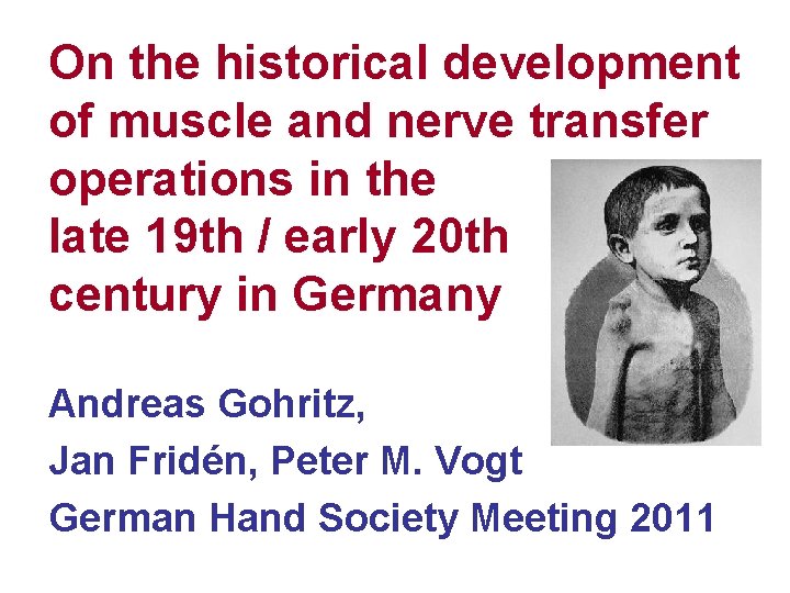 On the historical development of muscle and nerve transfer operations in the late 19 On the historical development of muscle and nerve transfer operations in the late 19